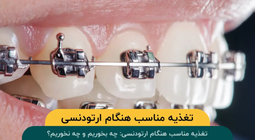 تغذیه-مناسب-هنگام-ارتودنسی
